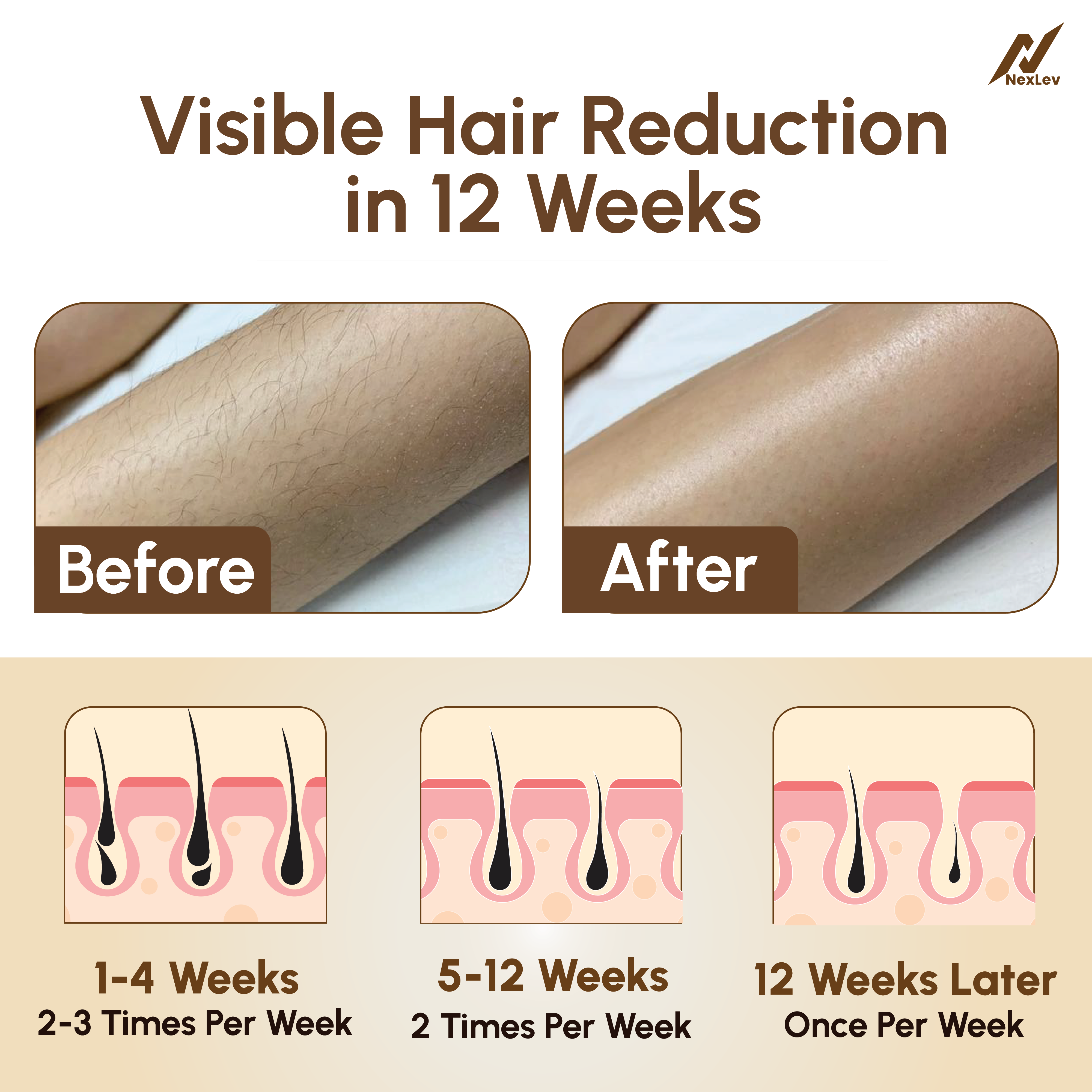 NexLev Laser Hair Remover Device | IPL-01